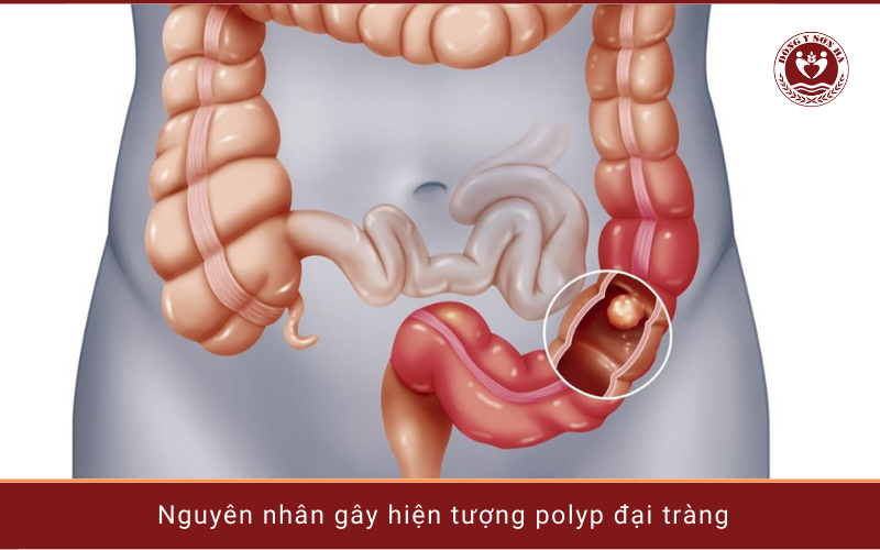 2. Tại sao xuất hiện polyp ở đại tràng?