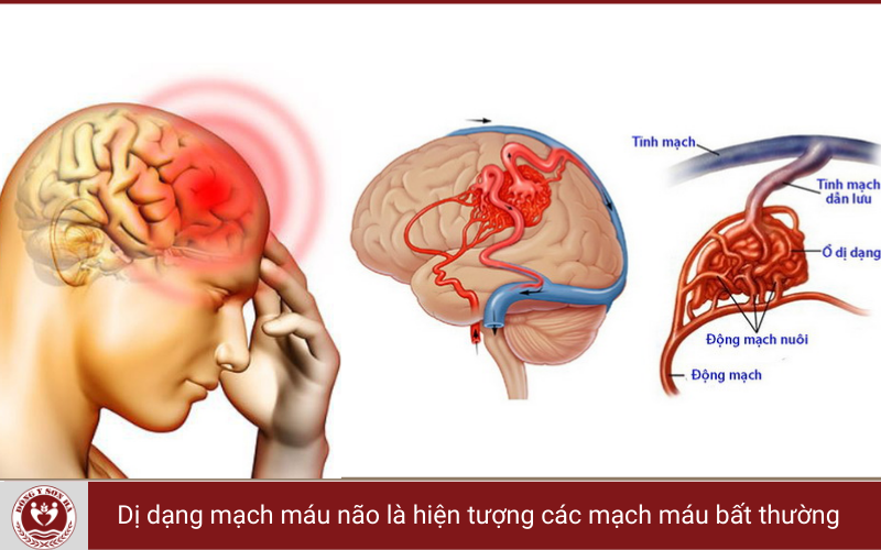 1. Dị dạng mạch máu não là gì?