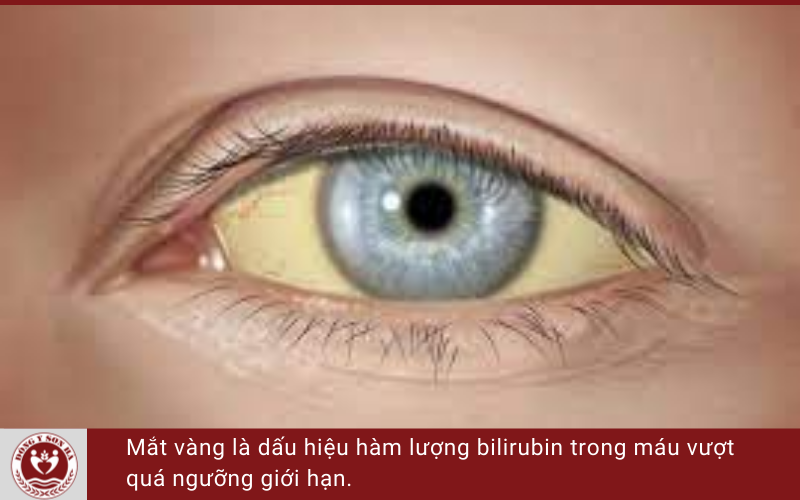 Mắt vàng - dấu hiệu bệnh về mắt