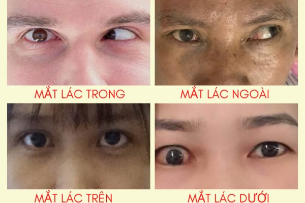 Tại sao bị mắt lác (lé), cách khắc phục an toàn hiệu quả?
