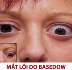 Chữa bệnh lồi mắt do Basedow bằng đông y