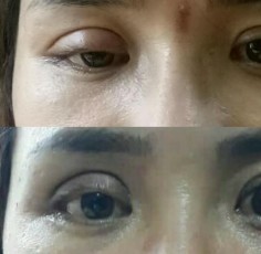 Tác hại của cắt mí mắt - Cách phục hồi không cần phẫu thuật