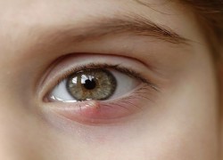 [Tổng hợp] 5+ cách trị lẹo mắt sau 1 đêm hiệu quả nhanh nhất