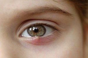 [Tổng hợp] 5+ cách trị lẹo mắt sau 1 đêm hiệu quả nhanh nhất