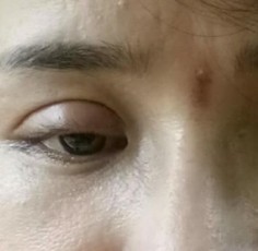 Tác hại của cắt mí mắt bị hư và cách điều trị hiệu quả