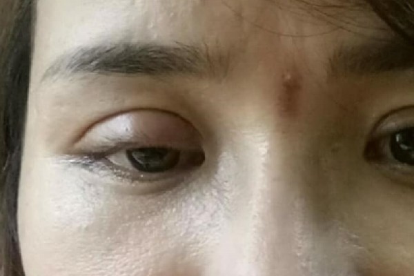 HÌNH ẢNH THỰC TẾ SAU 5 NGÀY CẮT MÍ MẮT