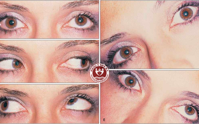 Các loại liệt dây thần kinh số 4