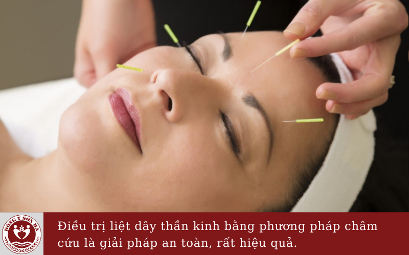 châm cứu chữa liệt dây thần kinh số 3