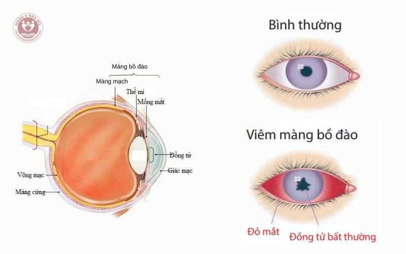 Viêm màng bồ đào là gì?