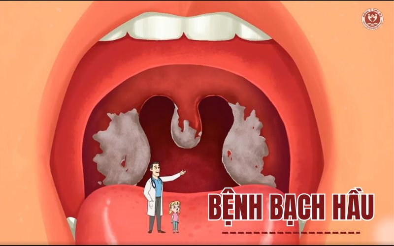 1. Bệnh bạch hầu là gì?