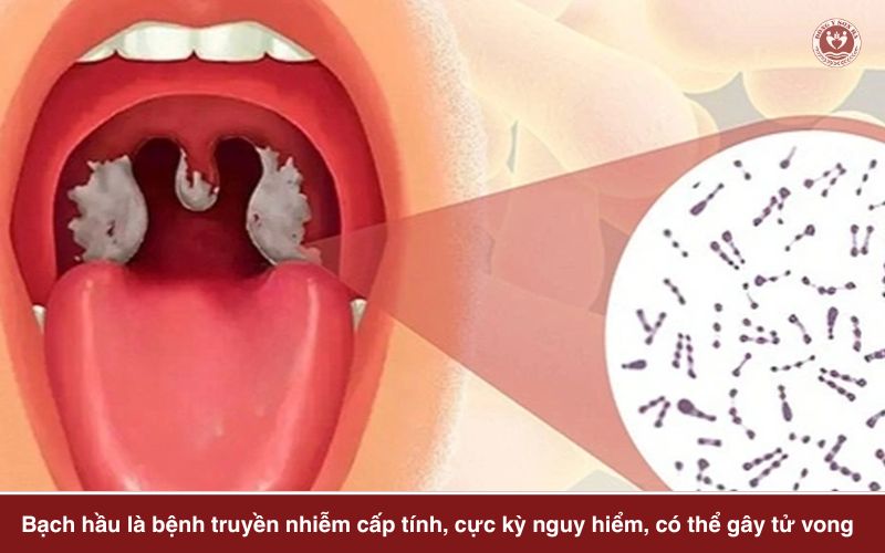 3. Điều trị bạch hầu như thế nào?