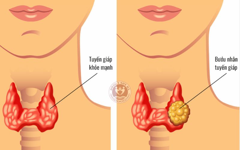Bệnh suy giáp là gì?