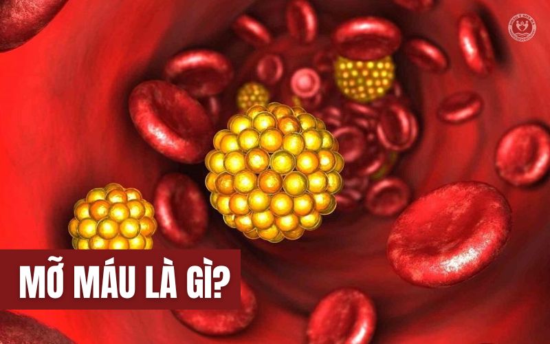 1. Mỡ máu là bệnh gì?