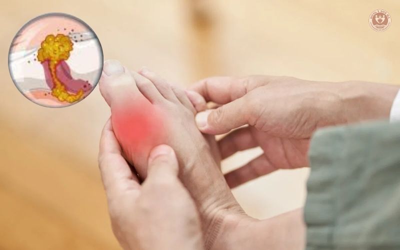 1. Bệnh gút là bệnh gì?