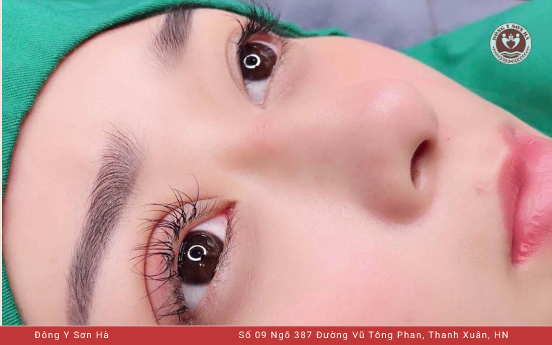 Lời khuyên trước khi cắt mí mắt