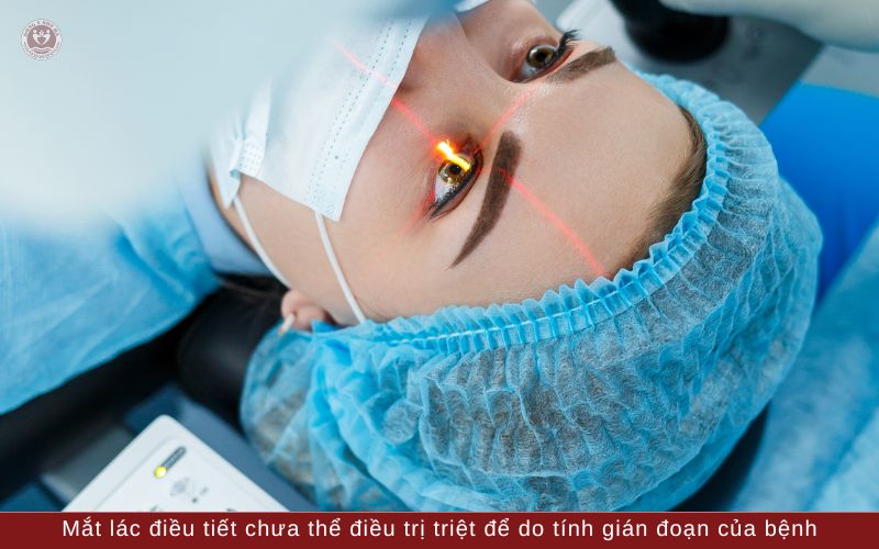 2. Điều trị mắt lác điều tiết