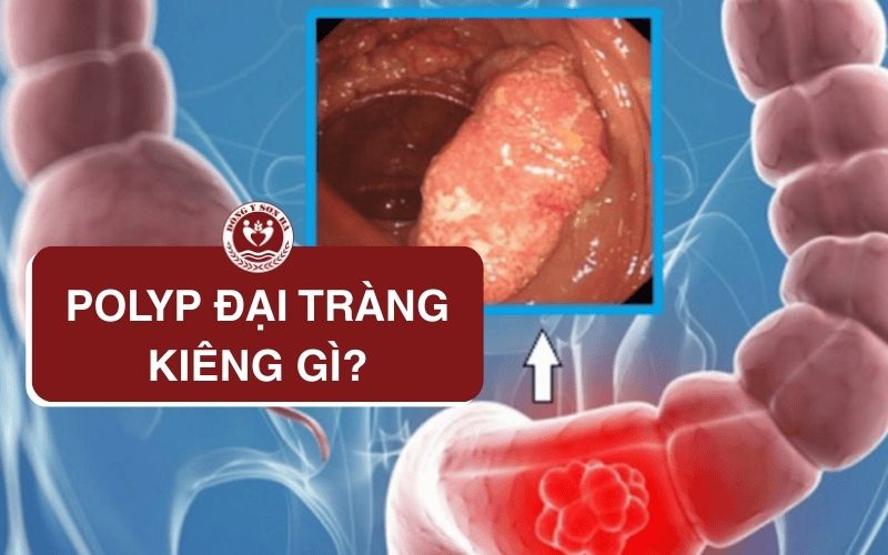 Polyp đại tràng nên kiêng gì?