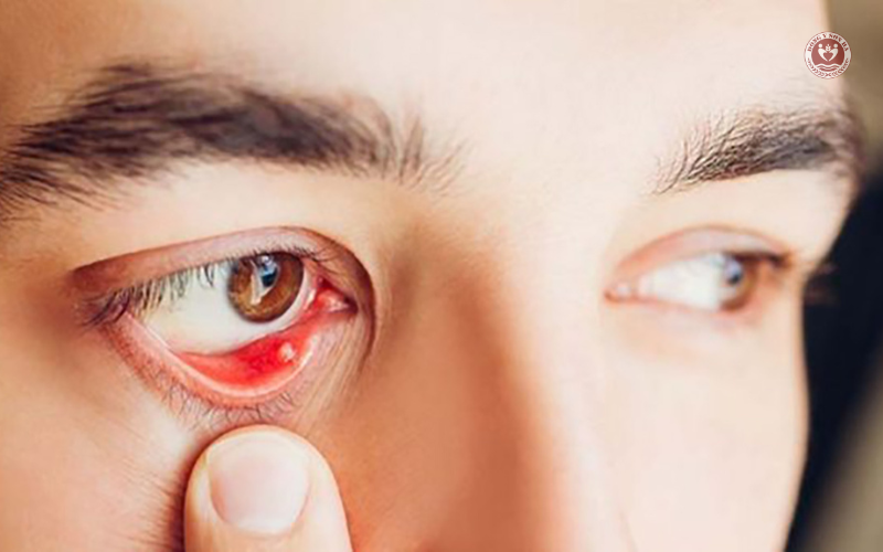 Các dạng đau mắt hột thường gặp