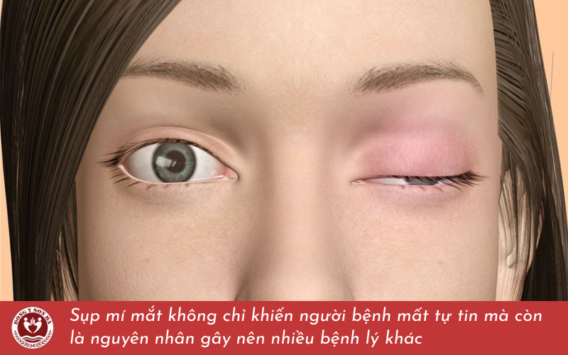 4. Hậu quả khôn lường của bệnh sụp mí mắt 