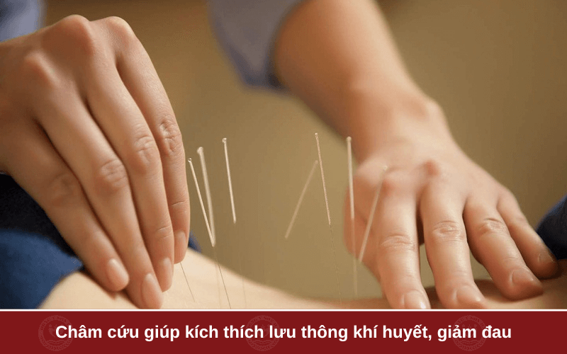 Chữa đau dây thần kinh tọa bằng Y Học Cổ Truyền