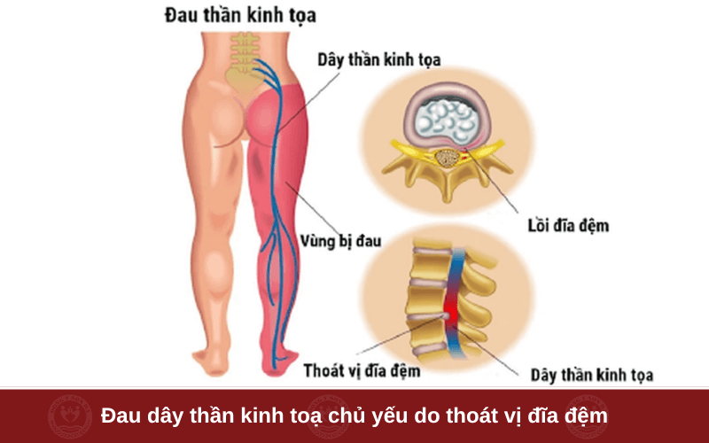 1. Đau dây thần kinh tọa là gì?