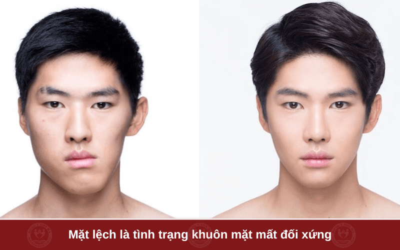 Mặt lệch là gì?