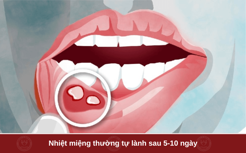 1. Nguyên nhân gây nhiệt miệng