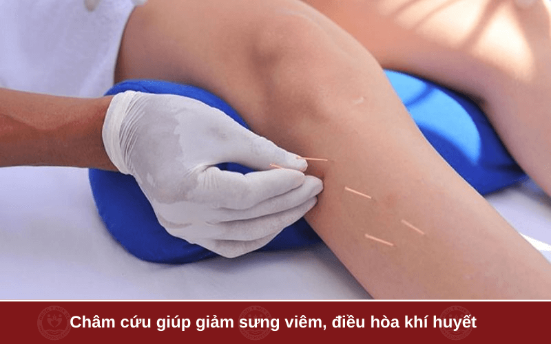 Châm cứu hỗ trợ điều trị tràn dịch khớp gối