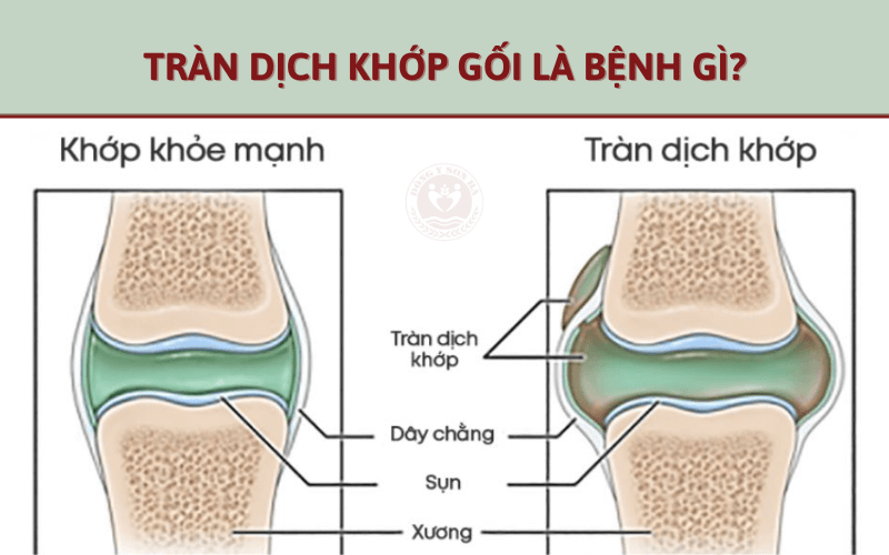 Tràn dịch khớp gối là bệnh gì?