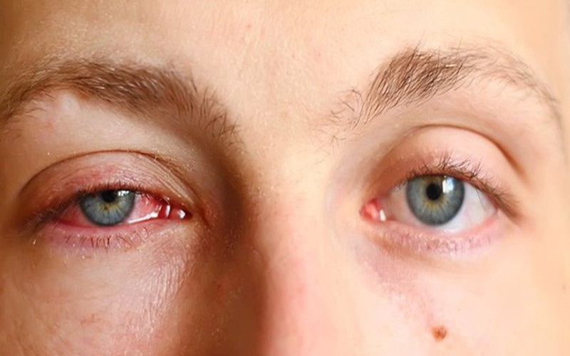 4. Biến chứng đau mắt đỏ cần lưu ý