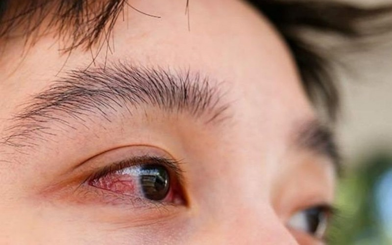 3. Triệu chứng đau mắt đỏ