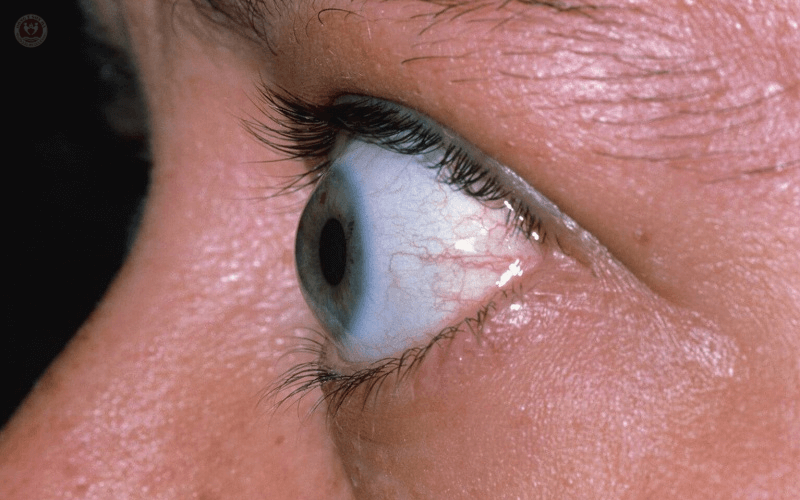 1. Những biến chứng nguy hiểm của mắt lồi