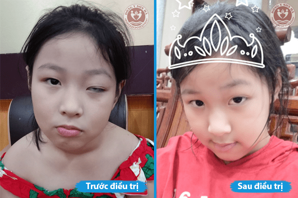 Hình ảnh bệnh nhân điều trị lác sụp mí tại Đông Y Sơn Hà