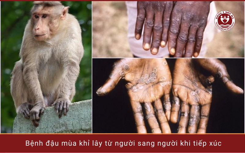 4. Bệnh đậu mùa khỉ lây truyền từ người sang người như thế nào?