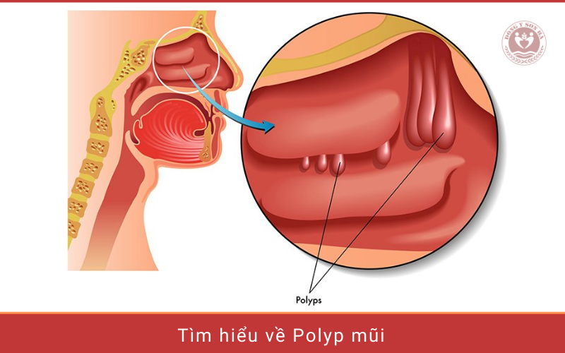 Tìm hiểu về bệnh polyp mũi