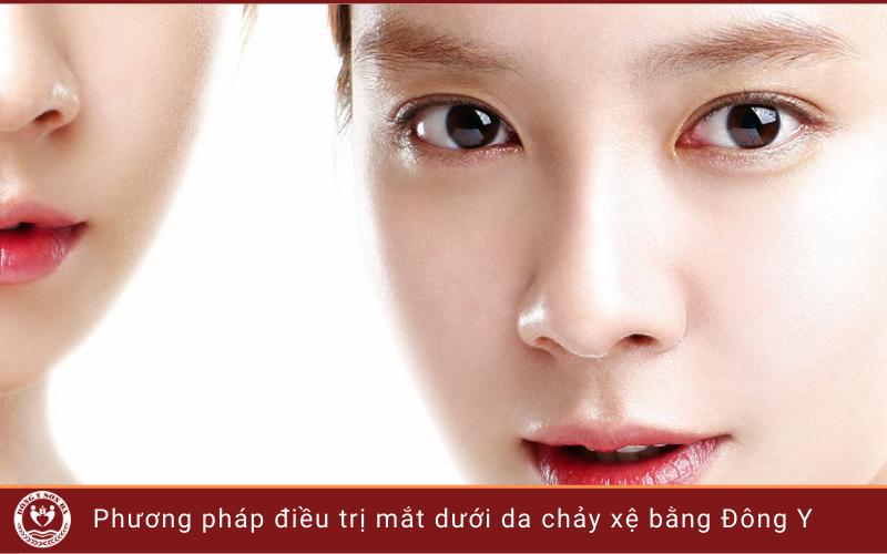 4. Căng vùng da dưới mắt bằng Đông y có hiệu quả không?