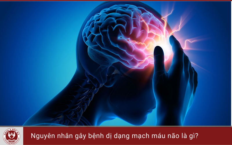 3. Nguyên nhân gây bệnh dị dạng mạch máu não