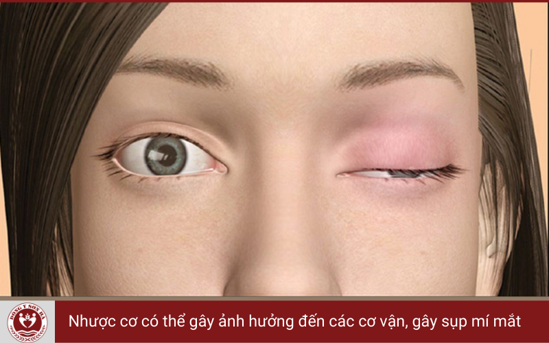 Nhược cơ có thể gây sụp mí mắt