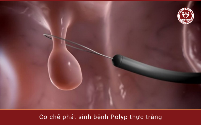 2. Cơ chế bệnh sinh polyp thực tràng