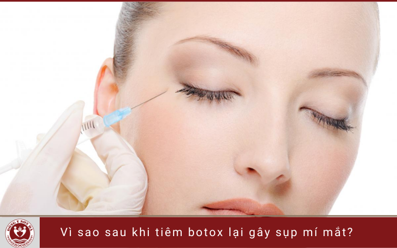 6. Vì sao sau khi tiêm botox gây sụp mí mắt?