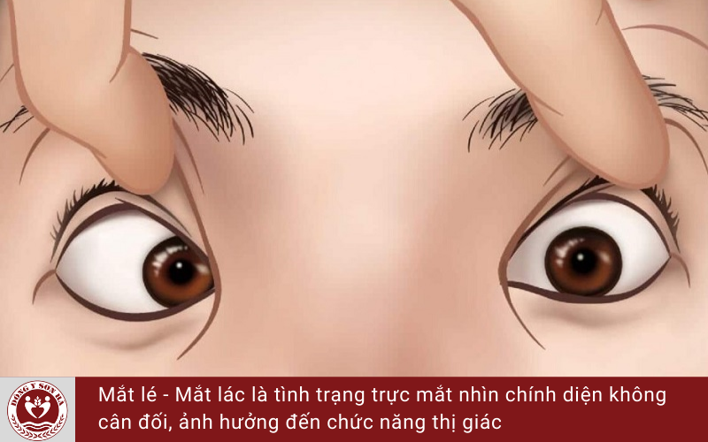 Hiện tượng mắt lé là gì?
