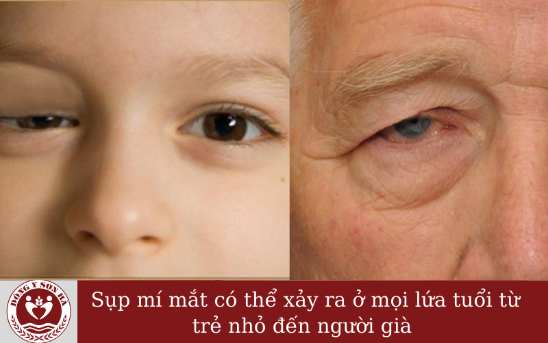 Sụp mí mắt thường xảy ra ở độ tuổi nào?