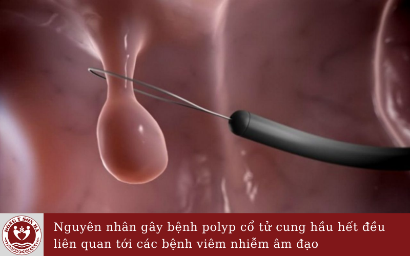 Nguyên nhân hình thành Polyp cổ tử cung