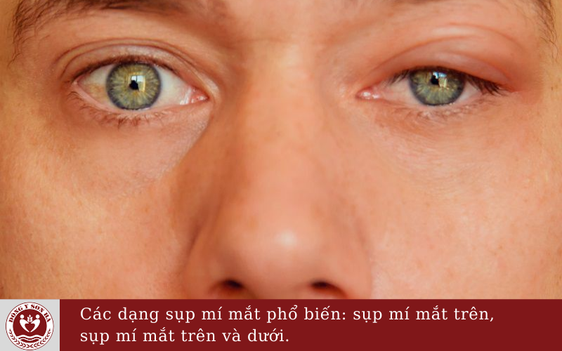 1. Sụp mí mắt là biểu hiện của nhiều bệnh lý nguy hiểm 