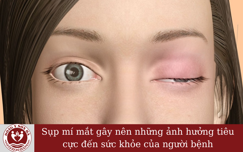 Các tác hại từ bệnh sụp mí mắt