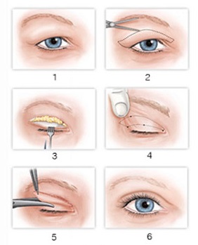 Chữa sụp mí mắt bằng can thiệp phẫu thuật